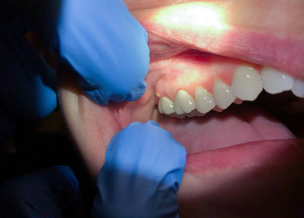 Best Dental Abscess Treatment in Humble, TX